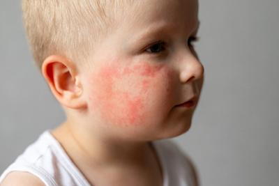 Child-with-Red-Rash-on-His-Cheek