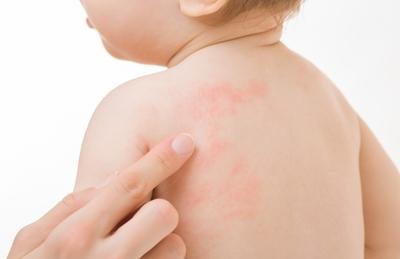 Close-up-of-a-baby’s-red-Skin-Rash-with-Irritation